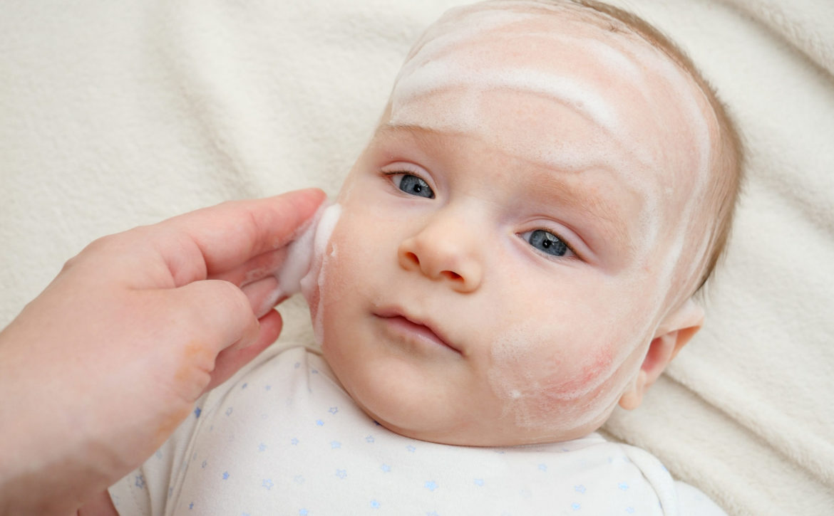 Applying curing lotion or ointment on baby cheeks suffering from dermatitis and acne. Concept of newborn baby hygiene, health and skin care