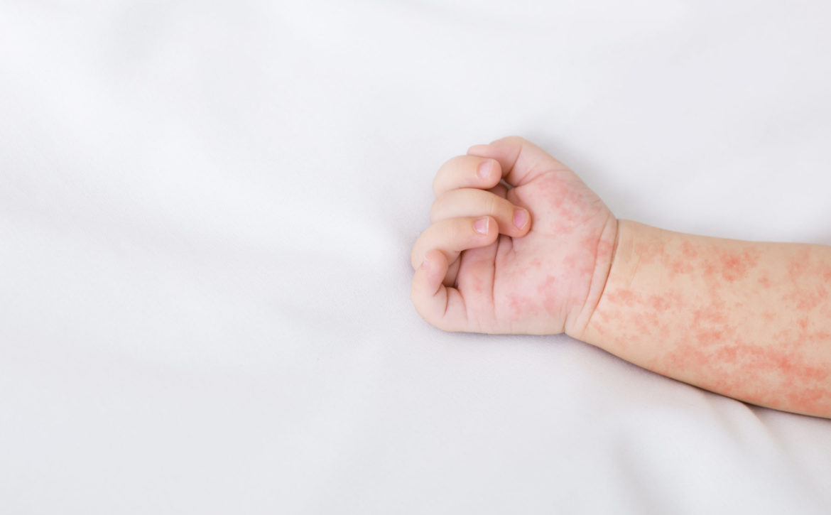 Hand of newborn baby with measles rash on white sheet